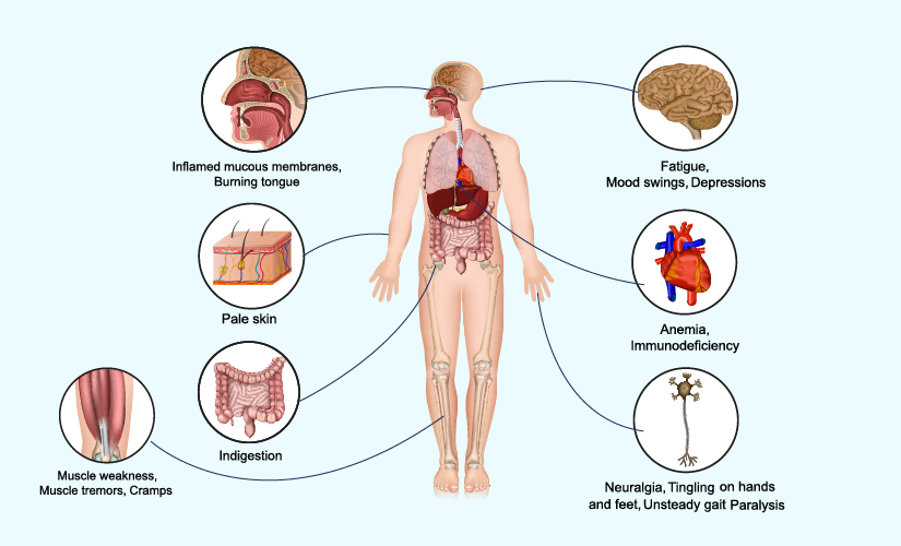 vitamin b12 deficiency1